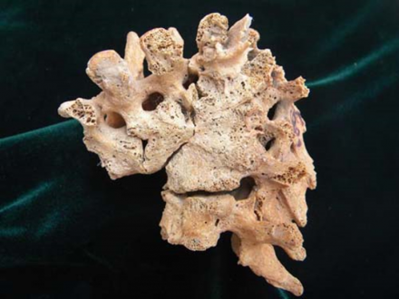 Avar kori spondylitis tuberculosa krónikus formája